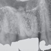 csm_Dentsply_ProTaperGold_Grafik_1_bbd721fb2c