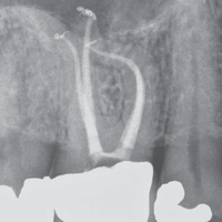 csm_Dentsply_ProTaperGold_Grafik_2_0682f83ddb