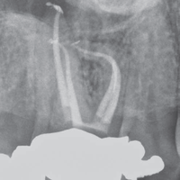 csm_Dentsply_ProTaperGold_Grafik_3_6ae691c9bd