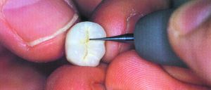 Fissuren-Feinfinierer 1