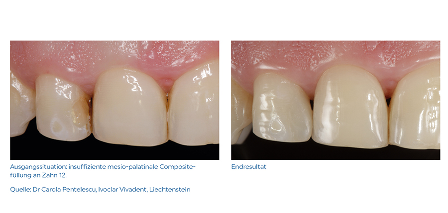 Frontzahnrestaurationen
