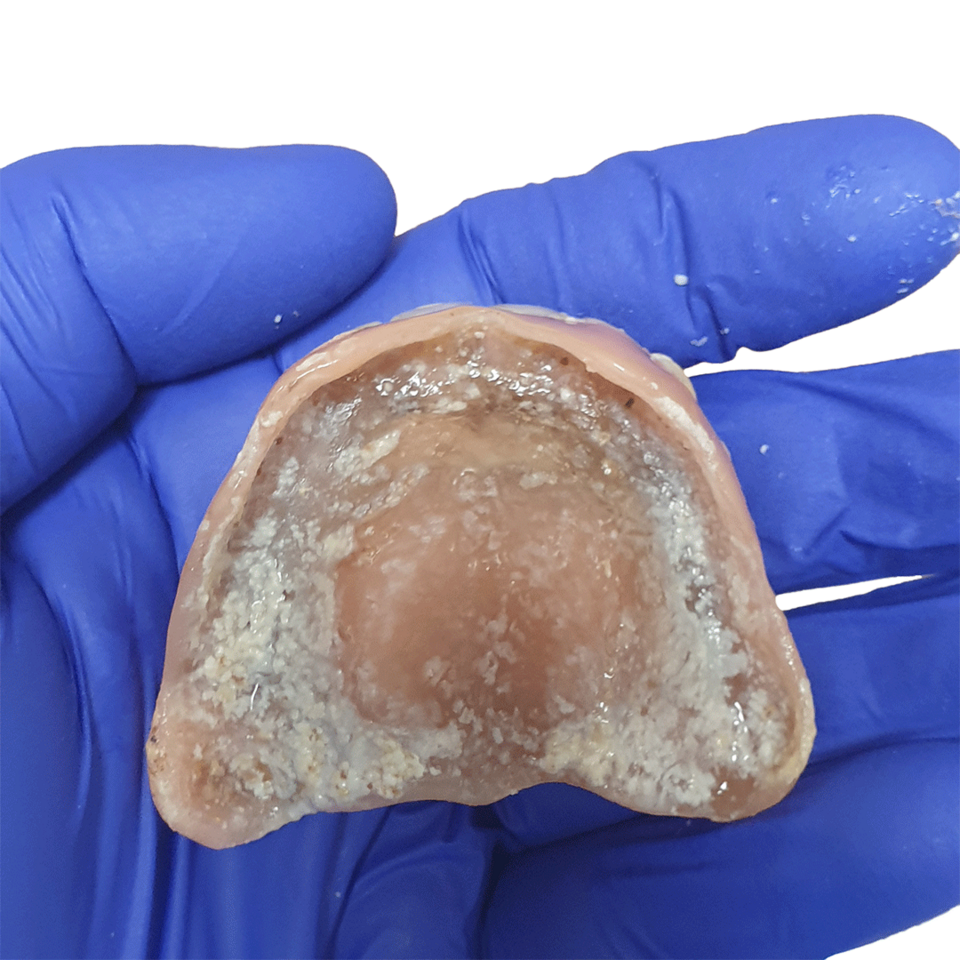 Effiziente Prothesenreinigung mit SYMPRO - Anwendung - Vorher - Bild 2