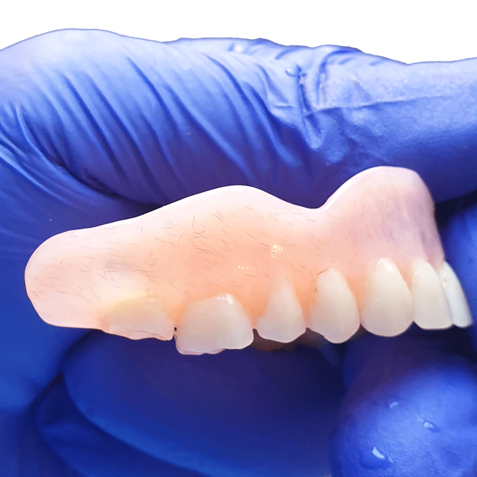 Effiziente Prothesenreinigung mit SYMPRO - Anwendung - Nachher - Bild 1